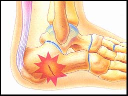 㲿ӦԹ(Stress Fractures in the Foot)