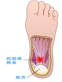 ׽Ĥ(ʹ֢) Plantar Fasciitis (Heel Pain)